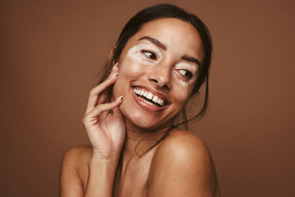 Entenda as causas e os tratamentos para o vitiligo